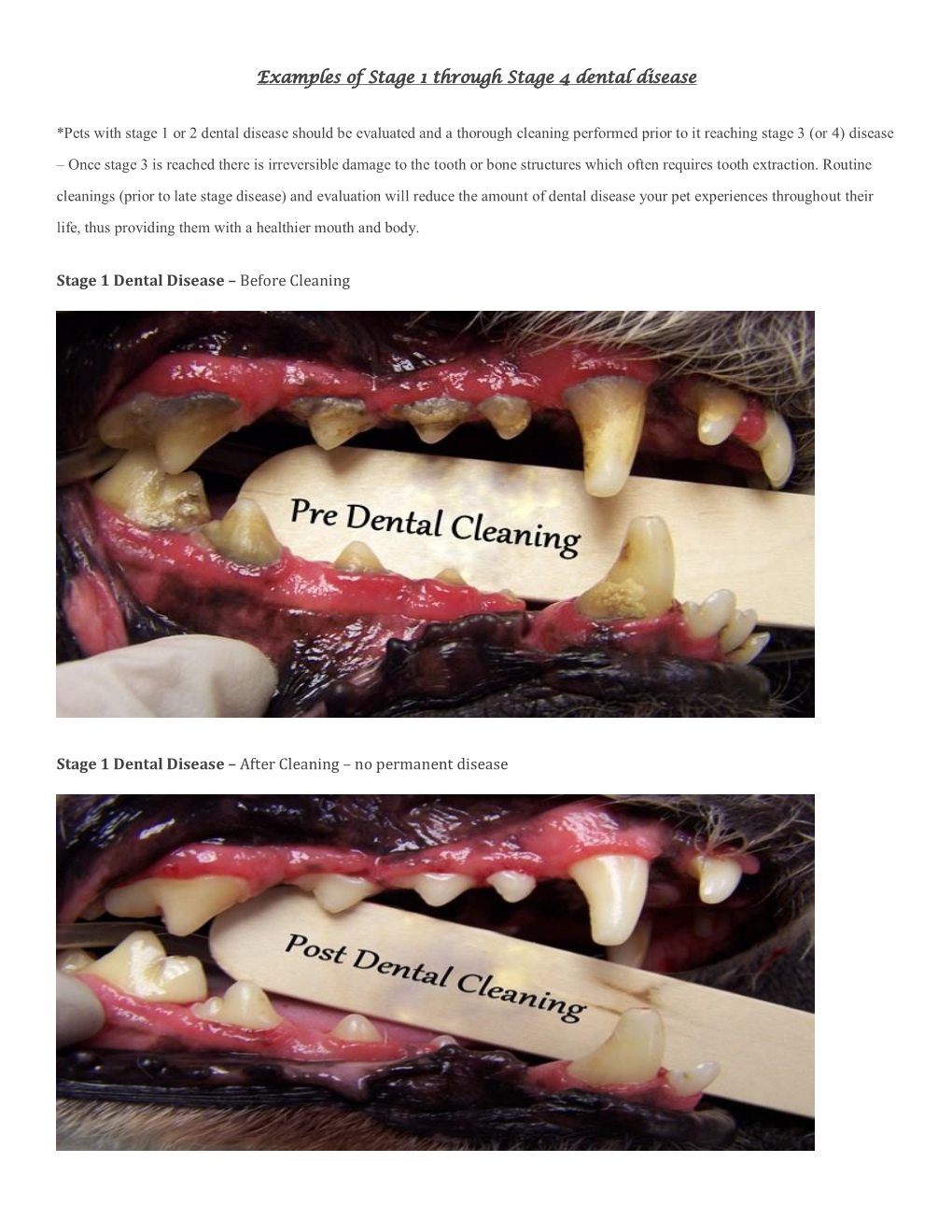 Four Stages of Dental Disease