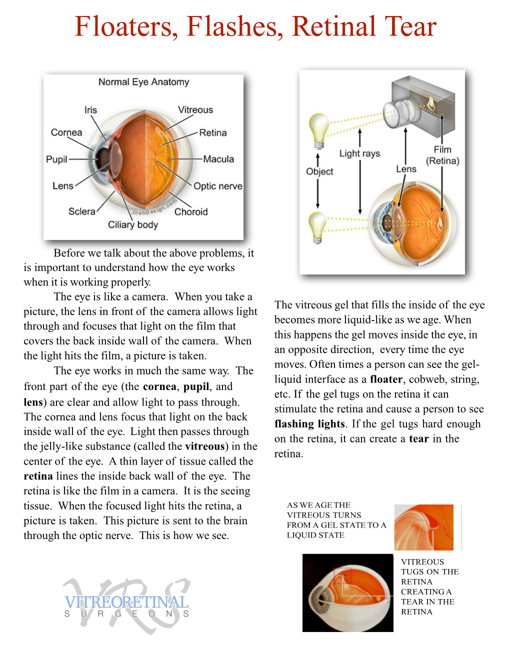 Floaters, Flashes, Retinal Tear