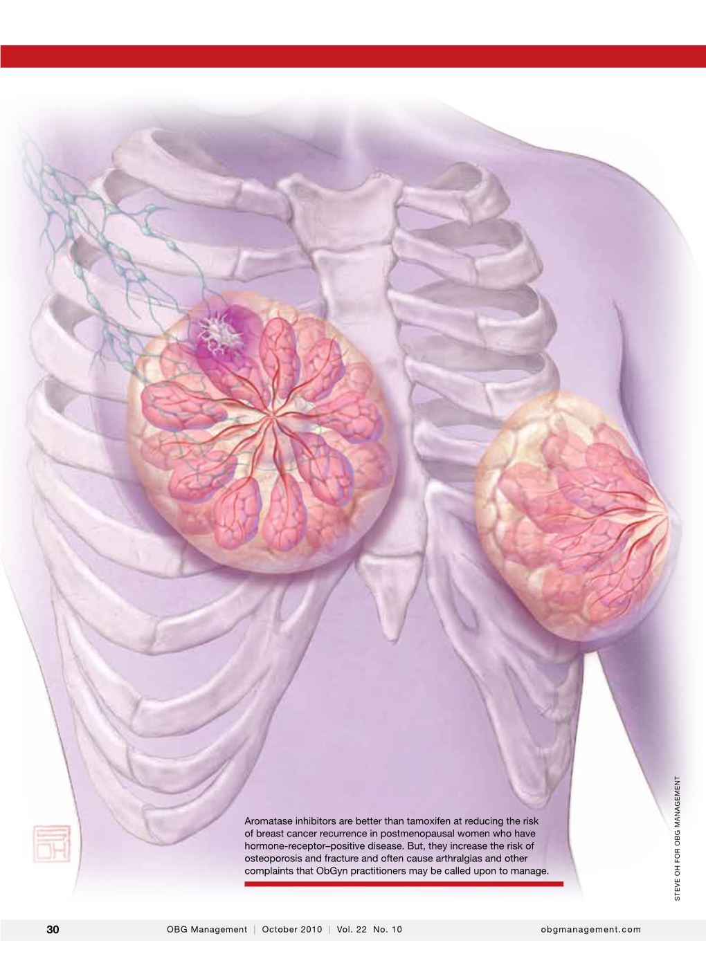 Aromatase Inhibitors Are Better Than Tamoxifen at Reducing the Risk of Breast Cancer Recurrence in Postmenopausal Women Who Have Ma