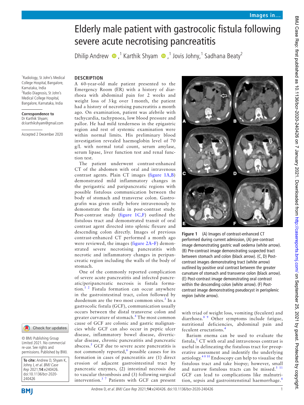 Elderly Male Patient with Gastrocolic Fistula Following Severe Acute Necrotising Pancreatitis Dhilip Andrew ‍ ‍ ,1 Karthik Shyam ‍ ‍ ,1 Jovis Johny,1 Sadhana Beaty2