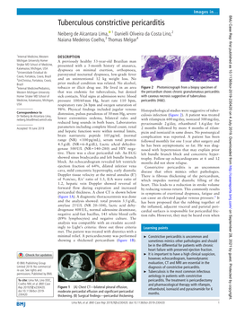 Tuberculous Constrictive Pericarditis Neiberg De Alcantara Lima, 1 Danielli Oliveira Da Costa Lino,2 Naiana Medeiros Coelho,3 Thomas Melgar4