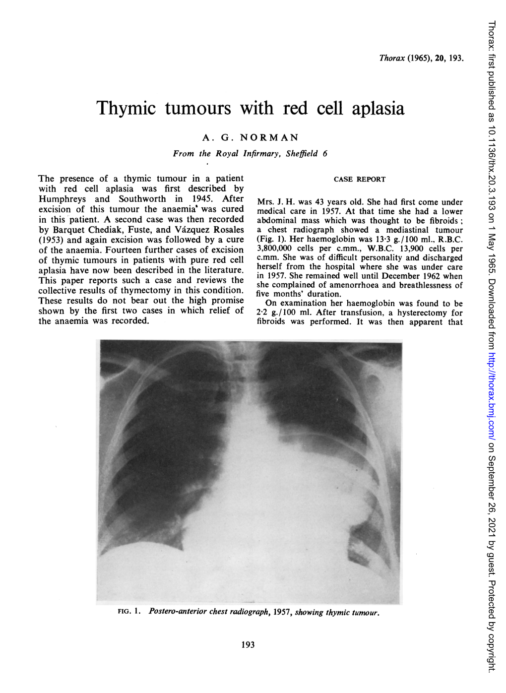 Thymic Tumours with Red Cell Aplasia