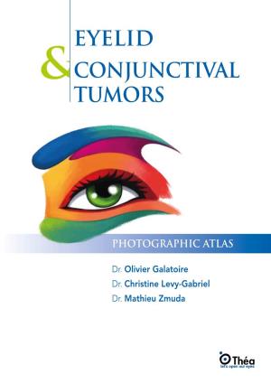Eyelid Conjunctival Tumors