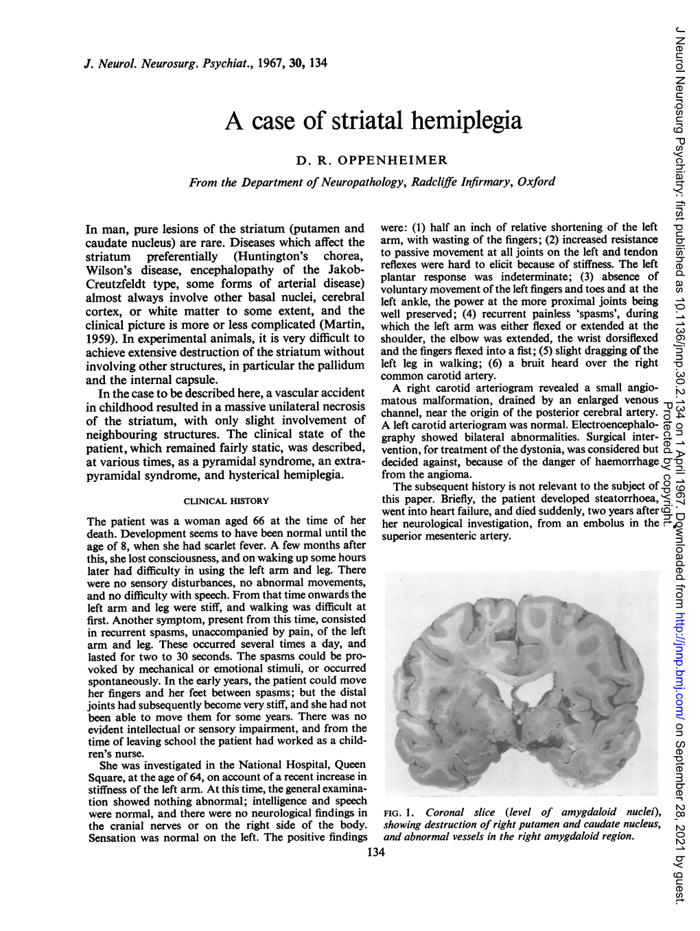 A Case of Striatal Hemiplegia