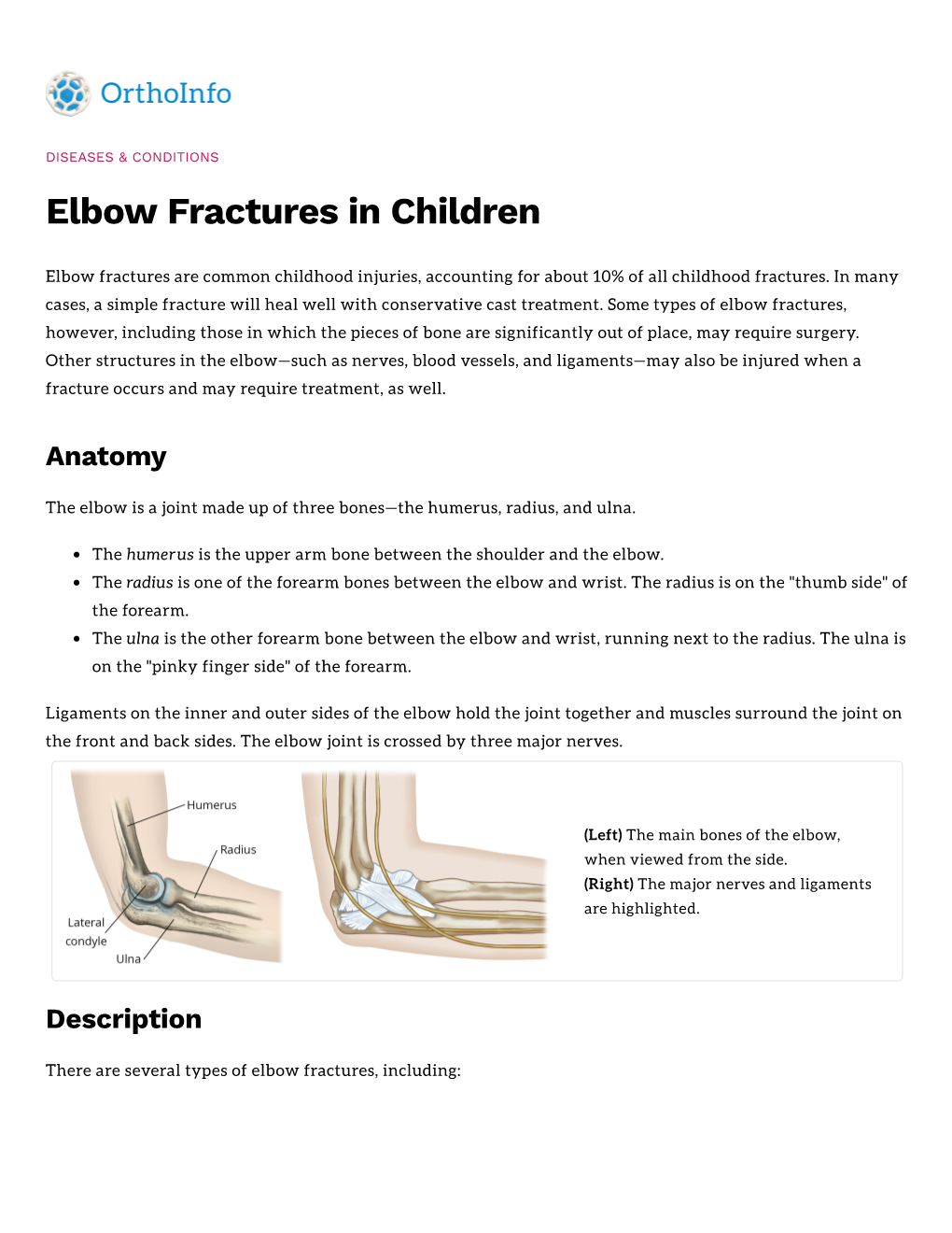 Elbow Fractures in Children