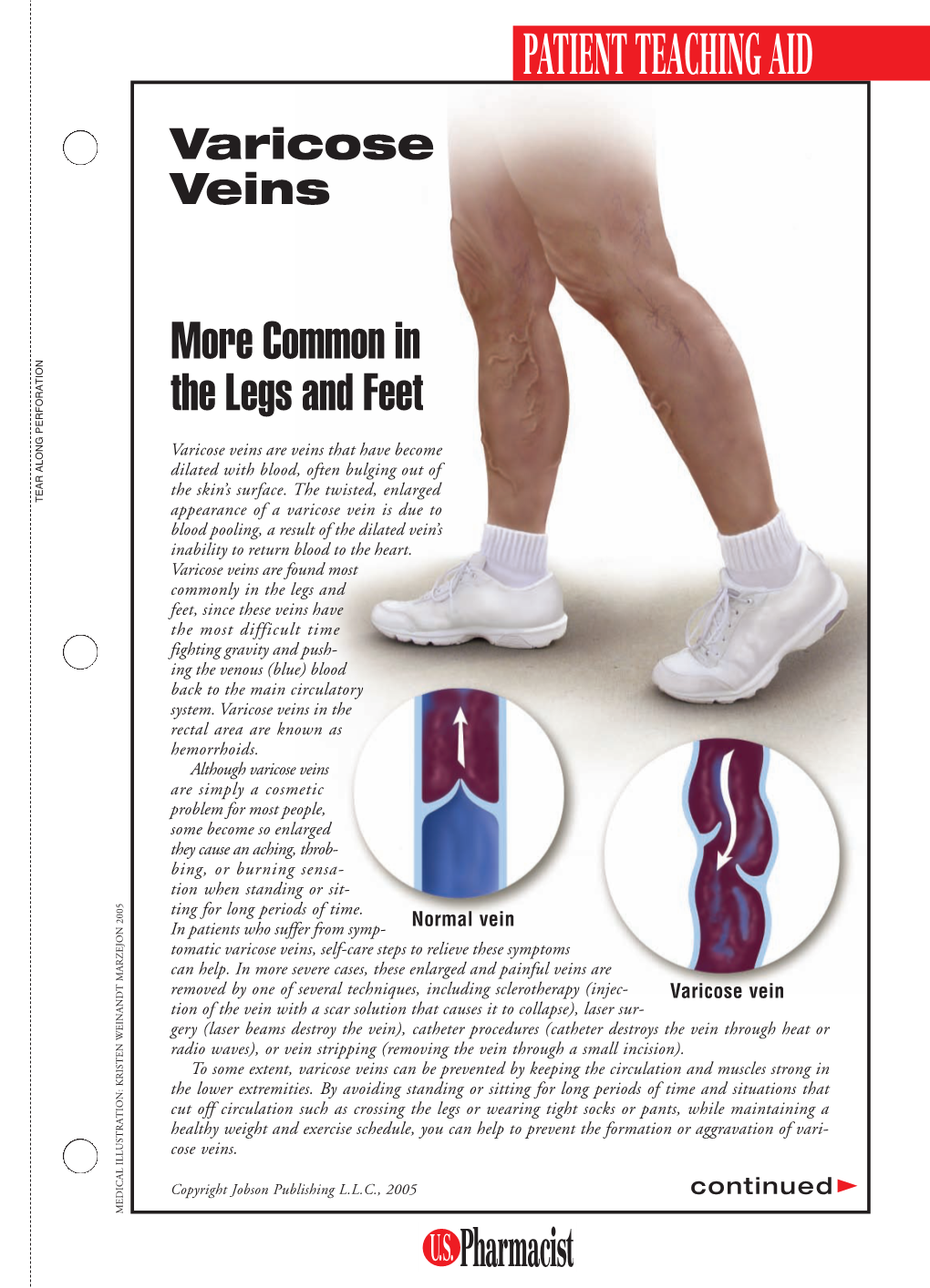 Varicose Veins