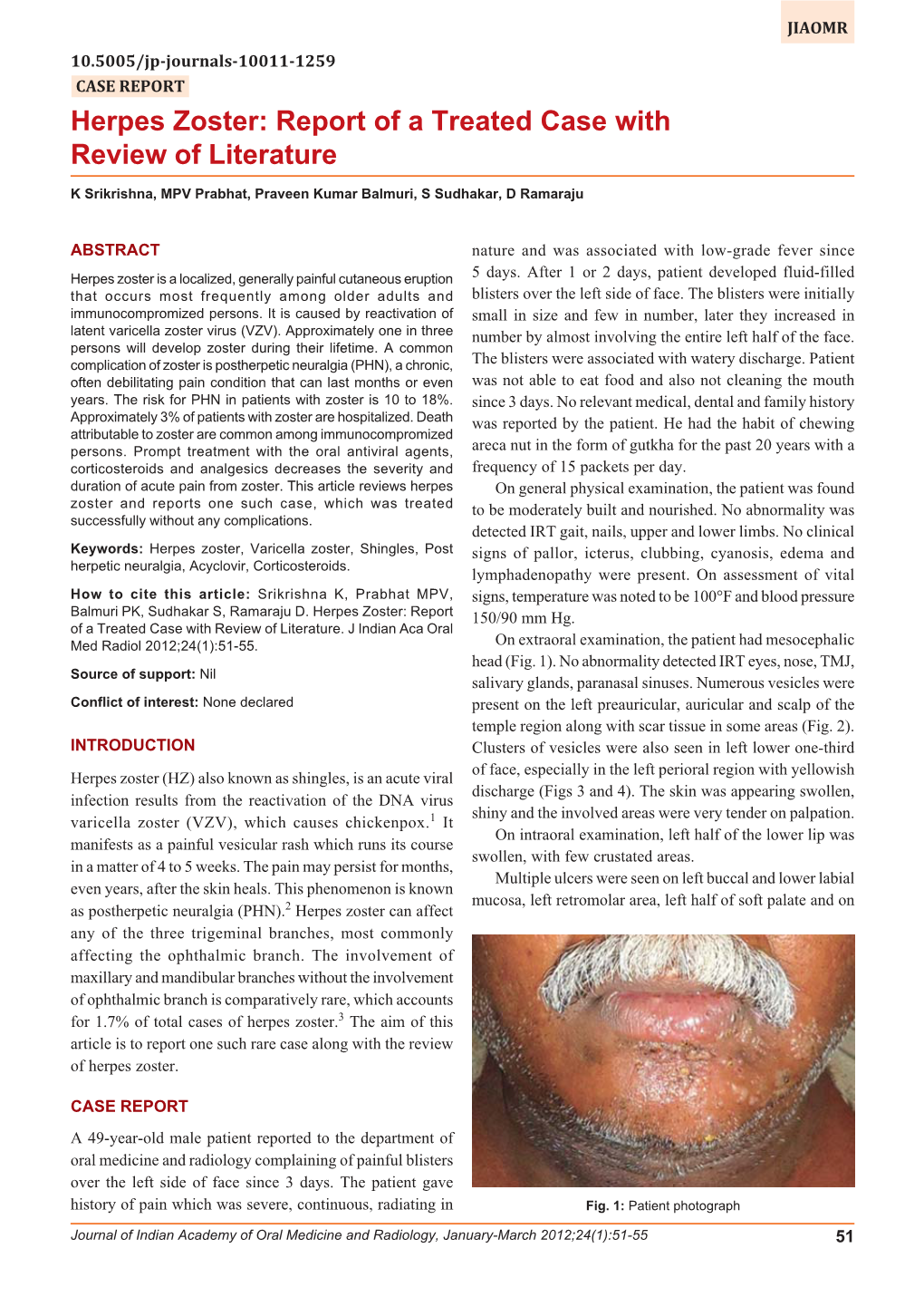 Herpes Zoster: Report of a Treated Case with Review of Literature Herpes Zoster: Report of a Treated Case with Review of Literature