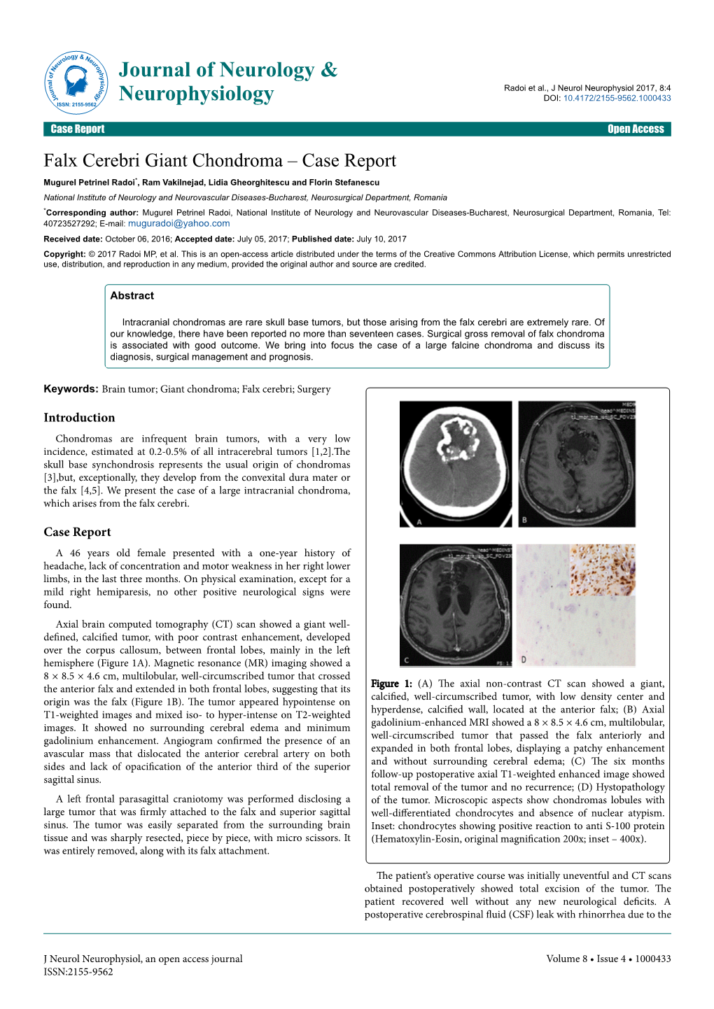 Falx Cerebri Giant Chondroma ‒ Case Report