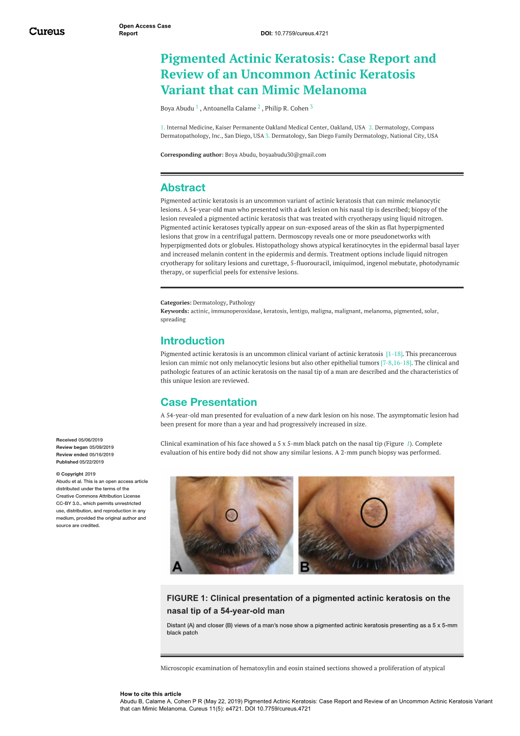 Pigmented Actinic Keratosis: Case Report and Review of an Uncommon Actinic Keratosis Variant That Can Mimic Melanoma