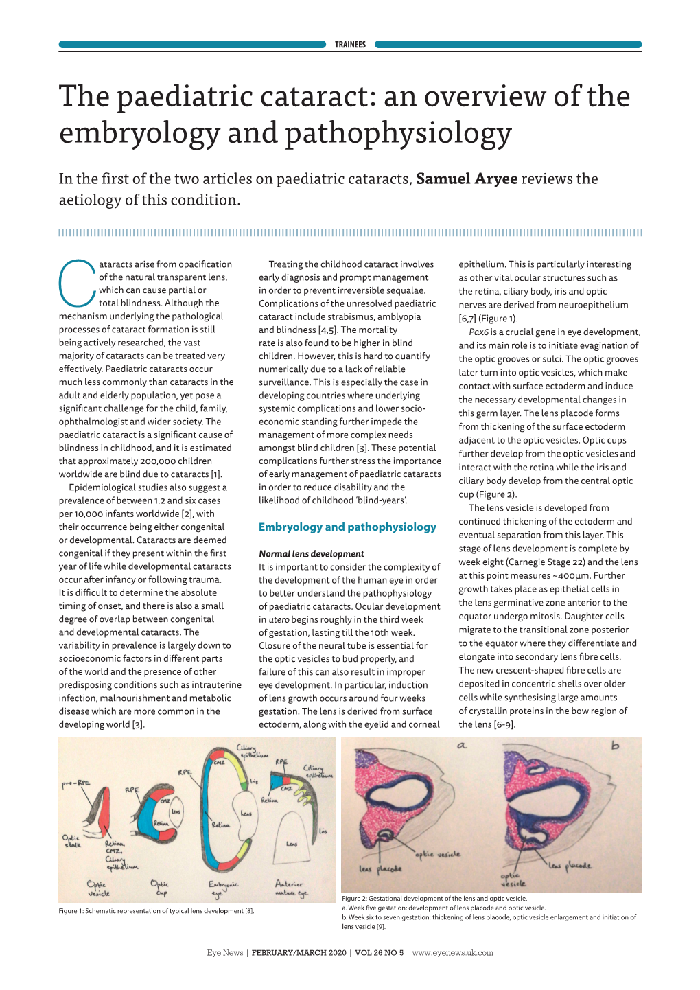 The Paediatric Cataract: an Overview of the Embryology and Pathophysiology