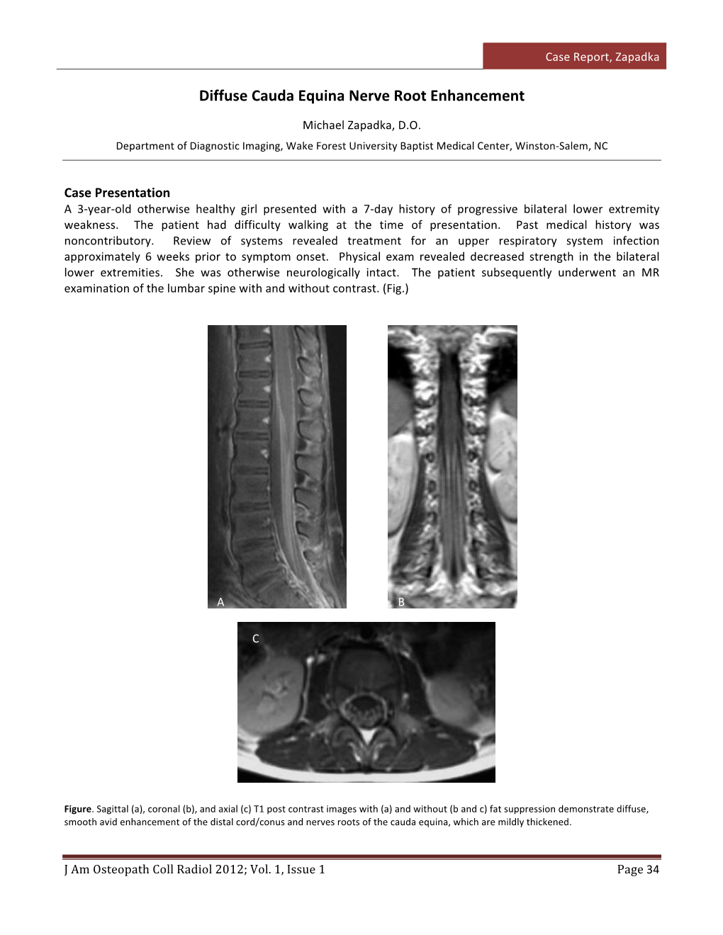 Diffuse Cauda Equina Nerve Root Enhancement