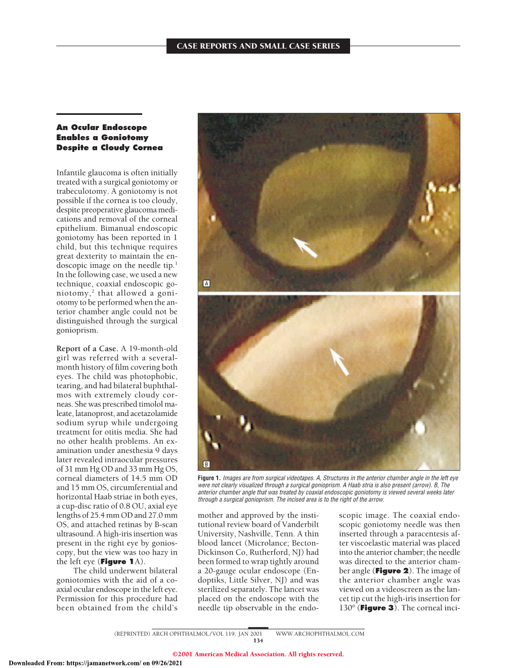 Spontaneous Peeling of Epiretinal Membrane Associated with Nd:YAG Laser Injury