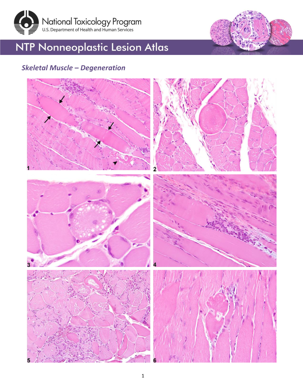 Skeletal Muscle – Degeneration