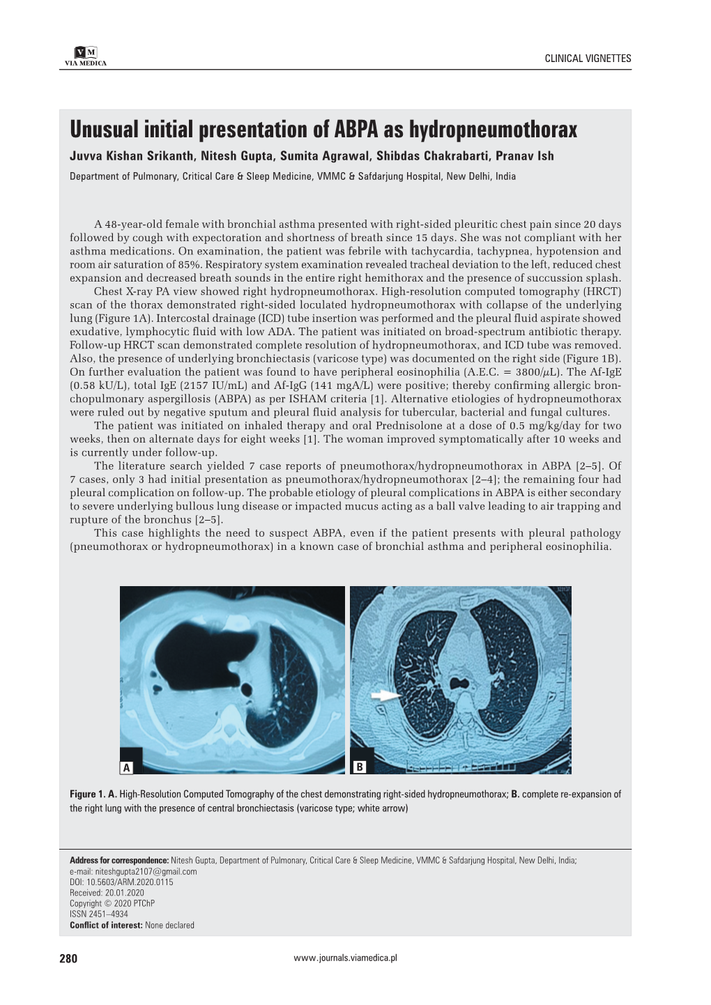 Unusual Initial Presentation of ABPA As