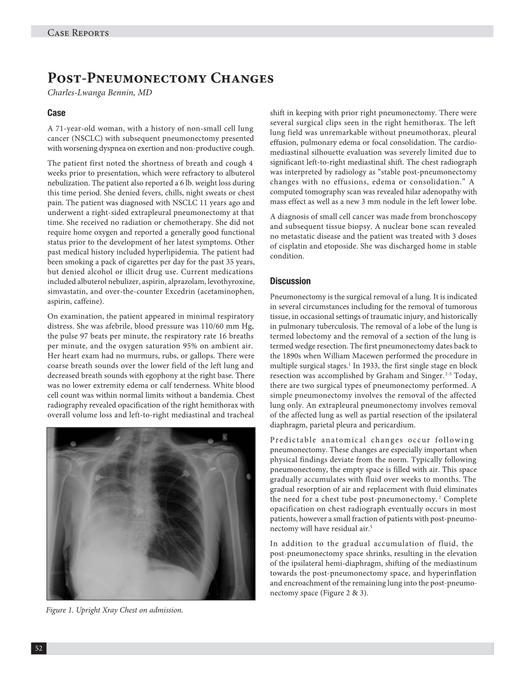 Post-Pneumonectomy Changes Charles-Lwanga Bennin, MD