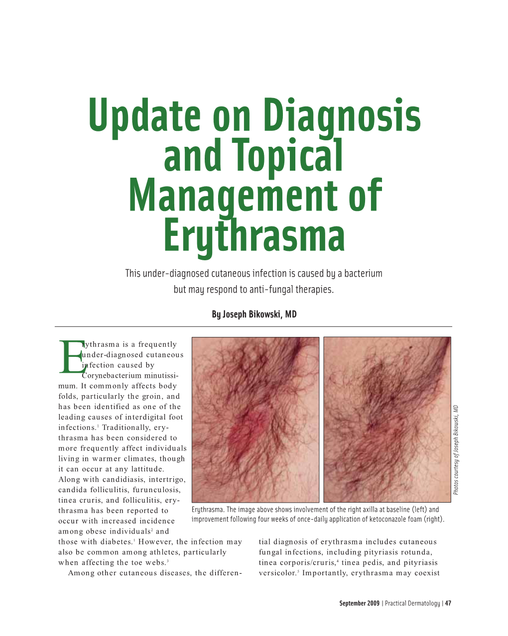 Update on Diagnosis and Topical Management of Erythrasma This Under-Diagnosed Cutaneous Infection Is Caused by a Bacterium but May Respond to Anti-Fungal Therapies