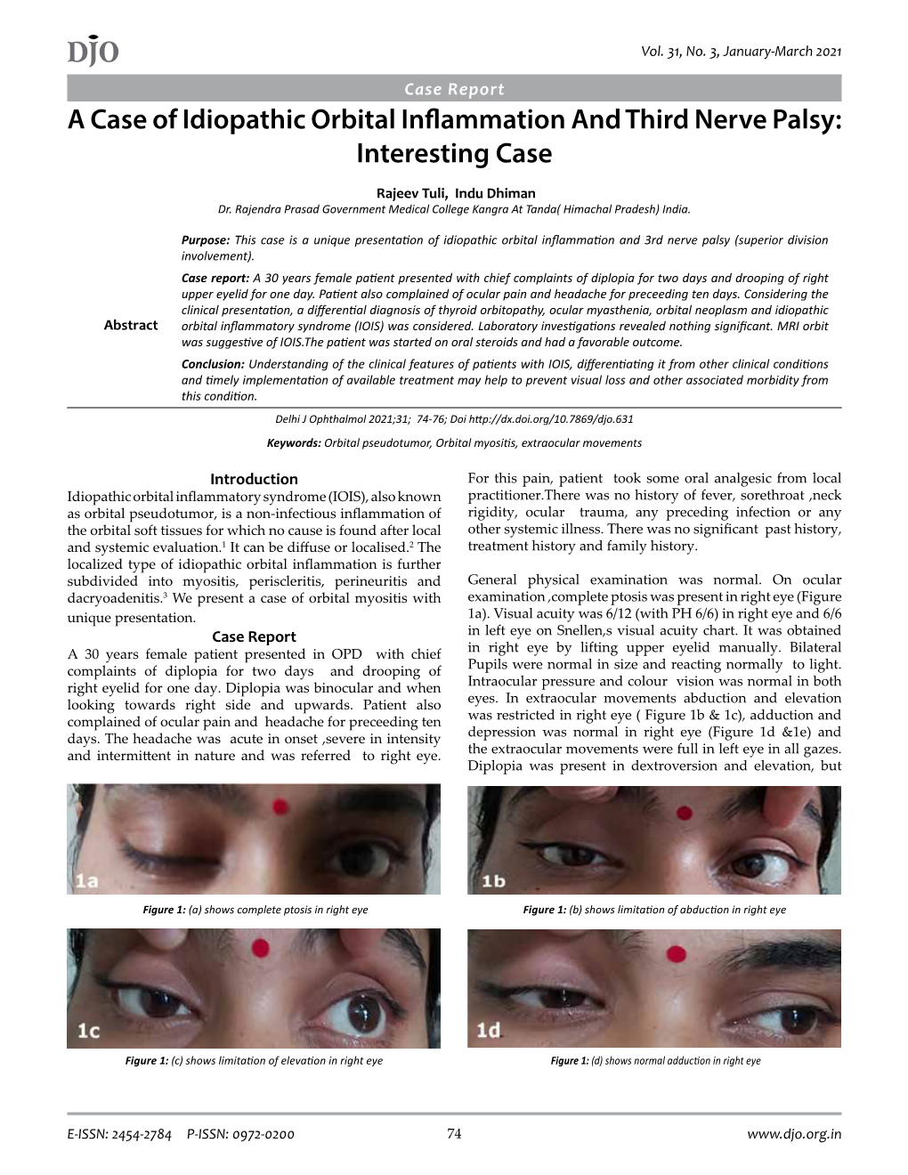 DJO a Case of Idiopathic Orbital Inflammation and Third Nerve Palsy