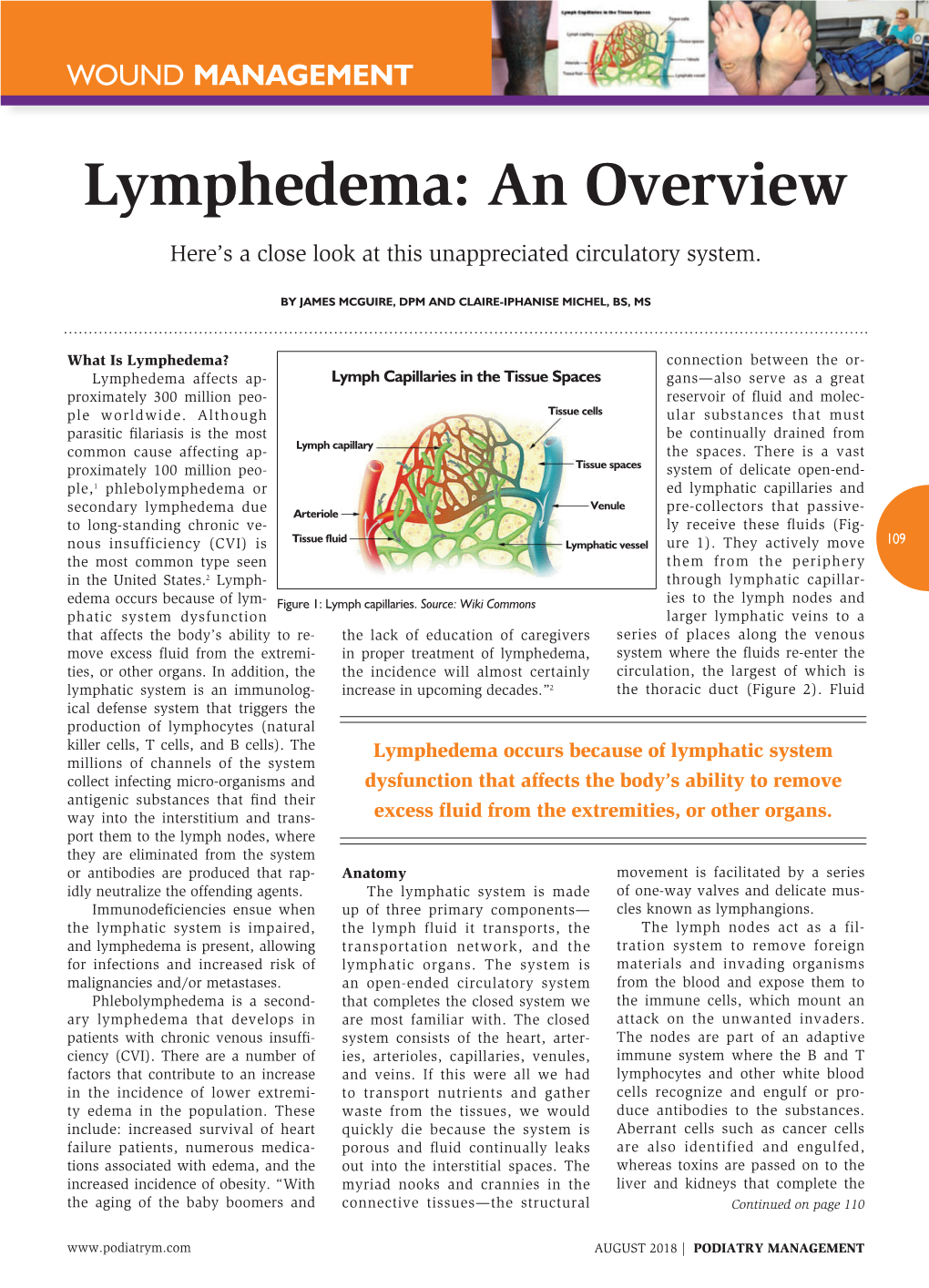 Lymphedema: an Overview Here’S a Close Look at This Unappreciated Circulatory System