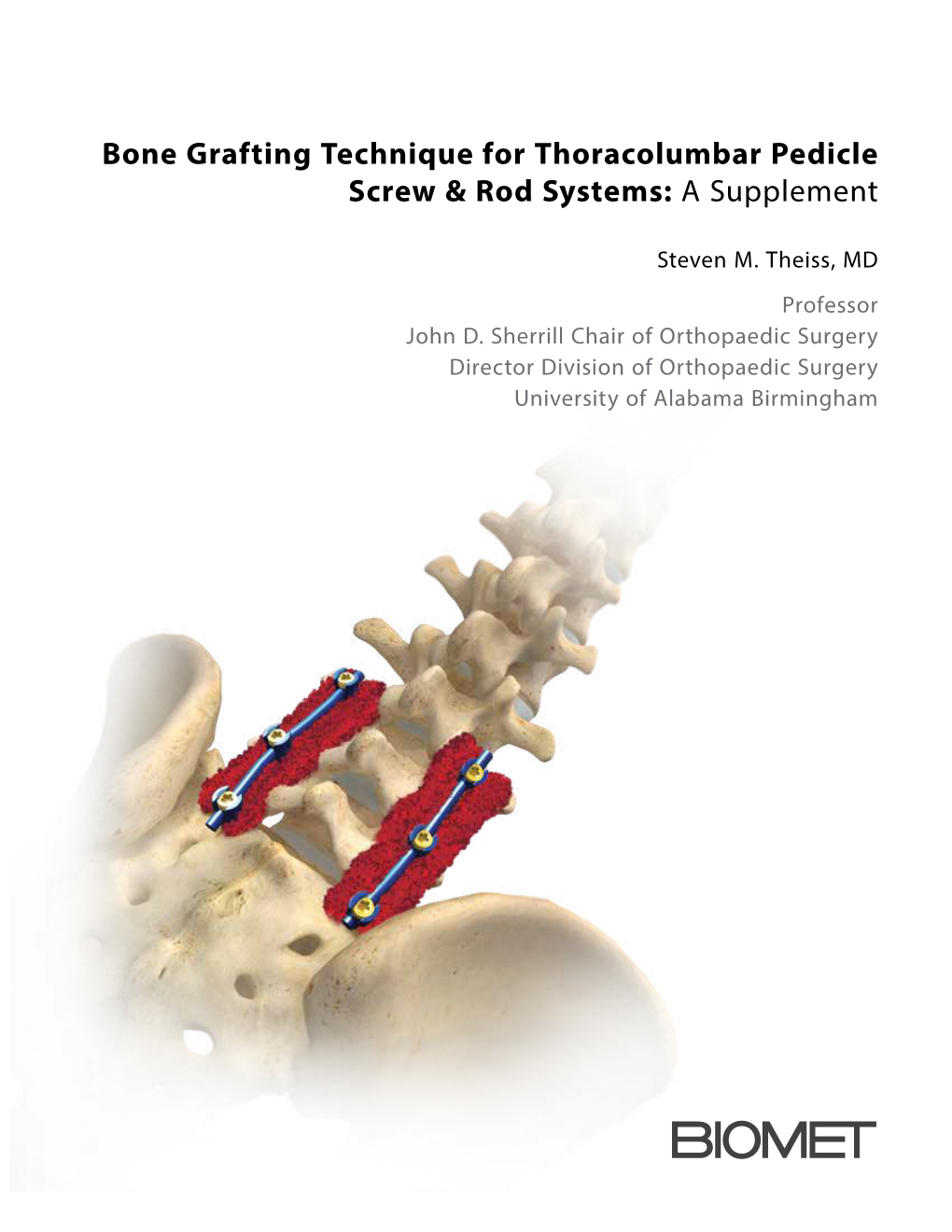 Bone Grafting Technique for Thoracolumbar Pedicle Screw & Rod Systems: a Supplement