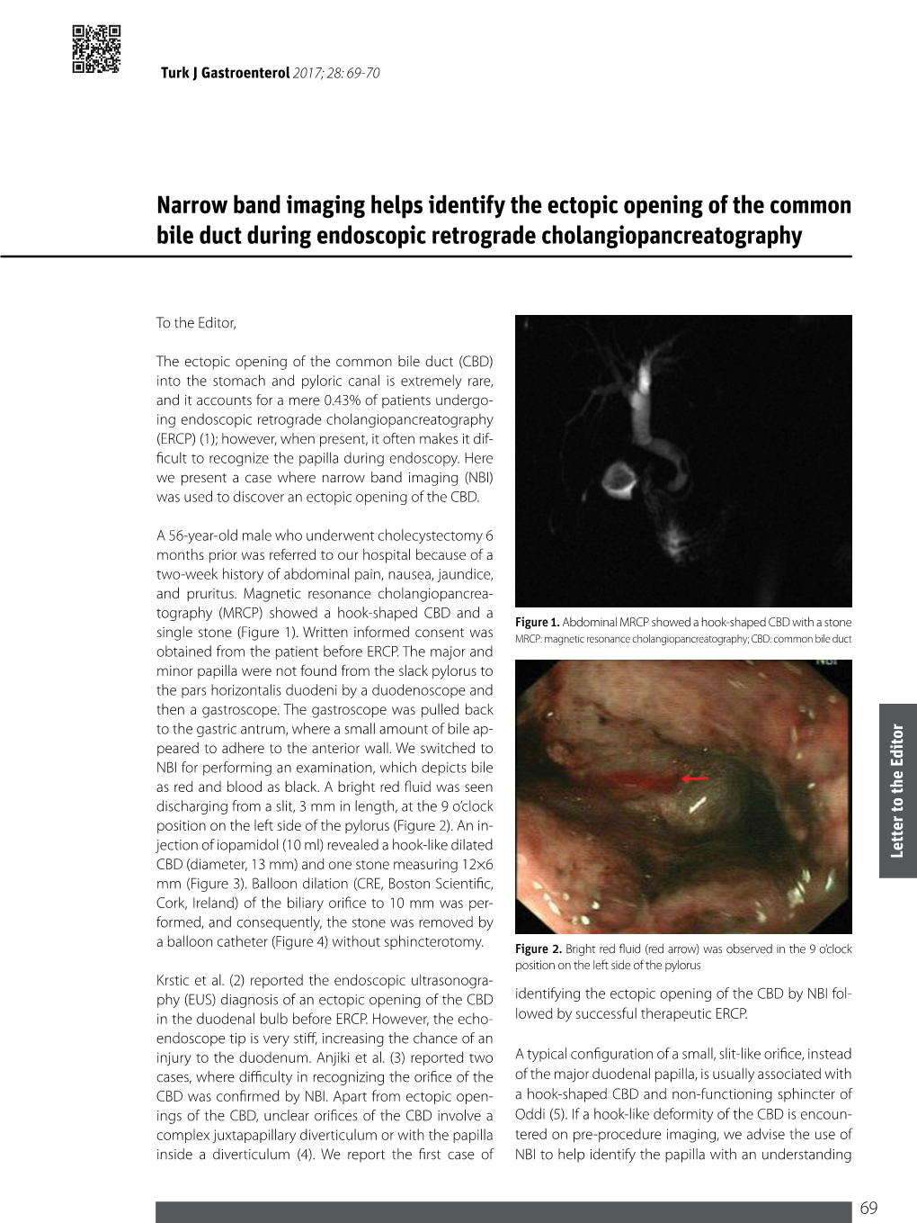 Narrow Band Imaging Helps Identify the Ectopic Opening of the Common Bile Duct During Endoscopic Retrograde Cholangiopancreatography