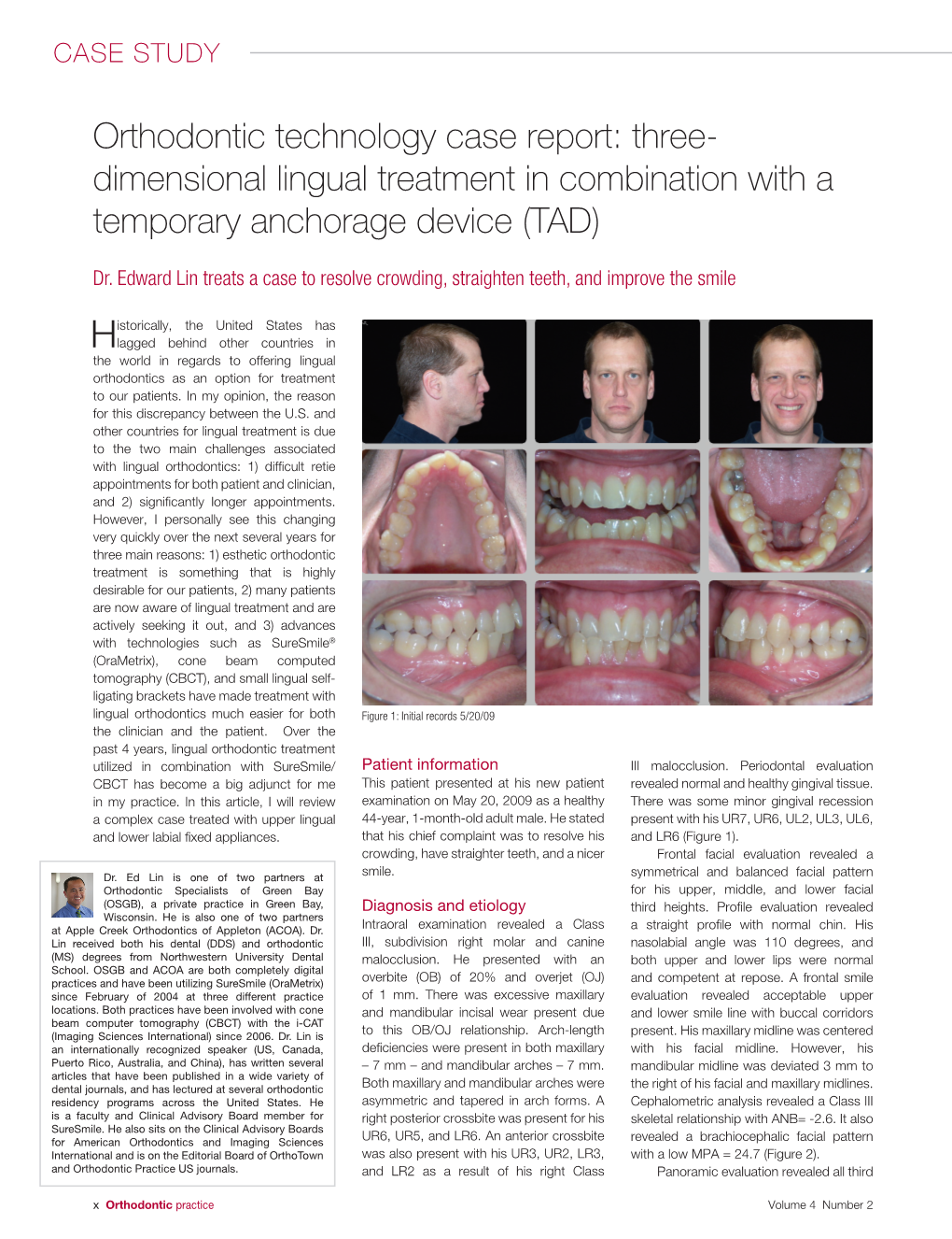 3D Lingual Treatment with Suresmile and Tads Case Report
