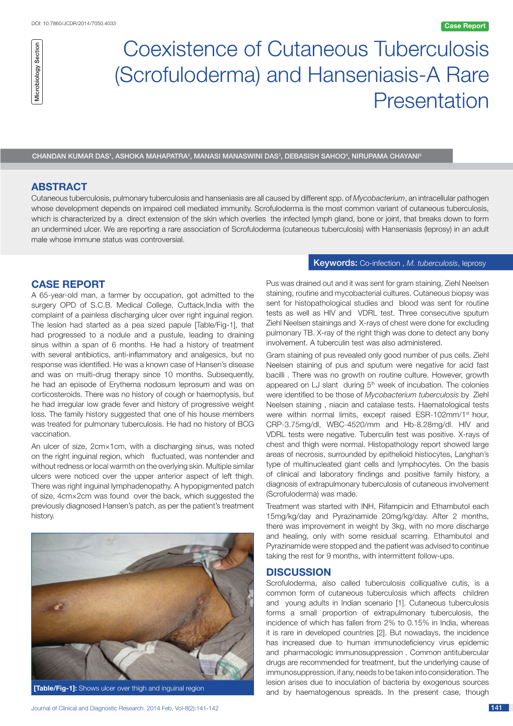 Coexistence of Cutaneous Tuberculosis (Scrofuloderma) and Hanseniasis-A Rare