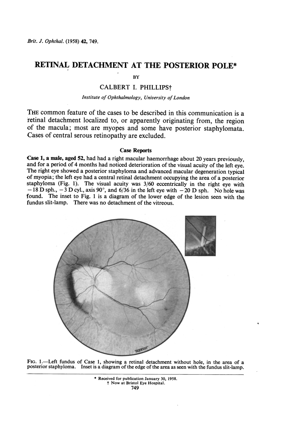 Retinal Detachment at the Posterior Pole* by Calbert I