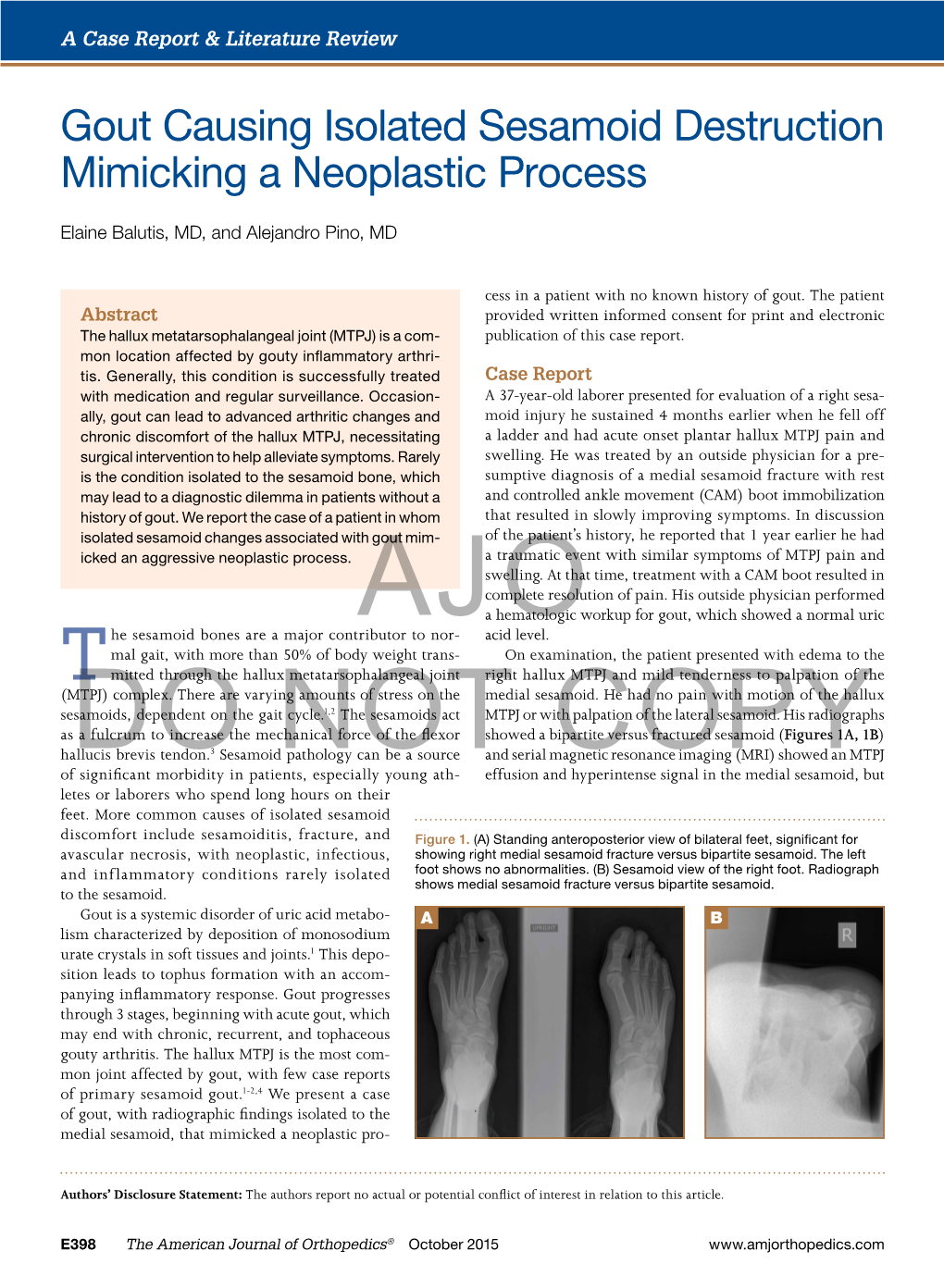 Gout Causing Isolated Sesamoid Destruction Mimicking a Neoplastic Process