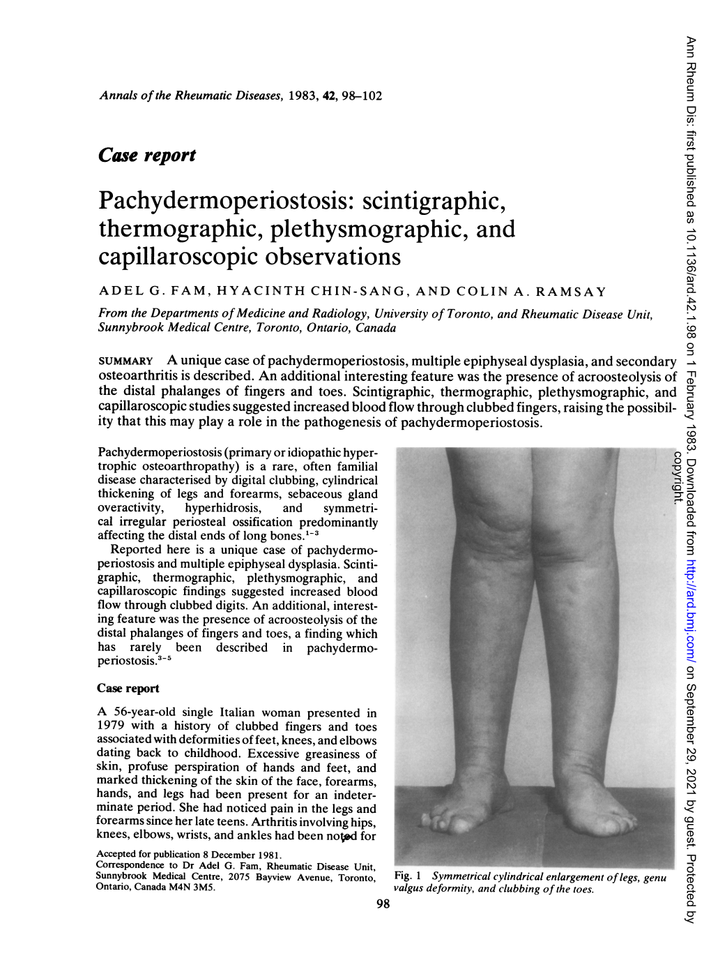 Pachydermoperiostosis: Scintigraphic, Thermographic, Plethysmographic, and Capillaroscopic Observations ADEL G