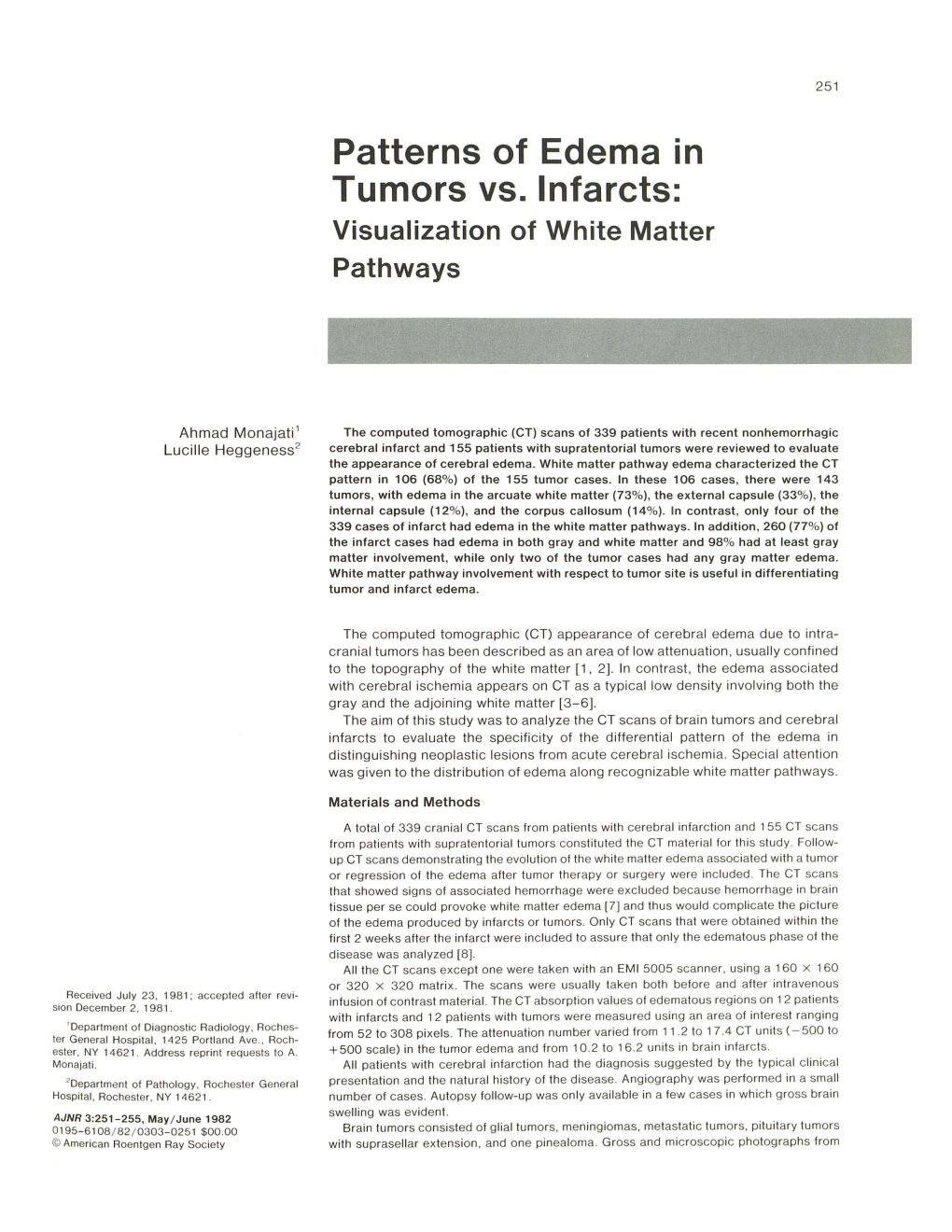 Patterns of Edema in Tumors Vs. Infarcts: Visualization of White Matter Pathways