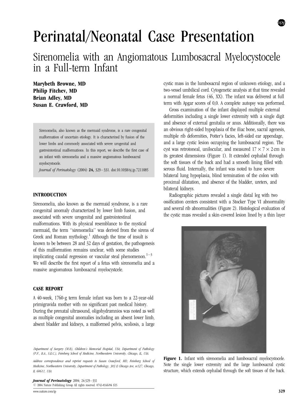 Perinatal/Neonatal Case Presentation Sirenomelia with an Angiomatous Lumbosacral Myelocystocele in a Full-Term Infant