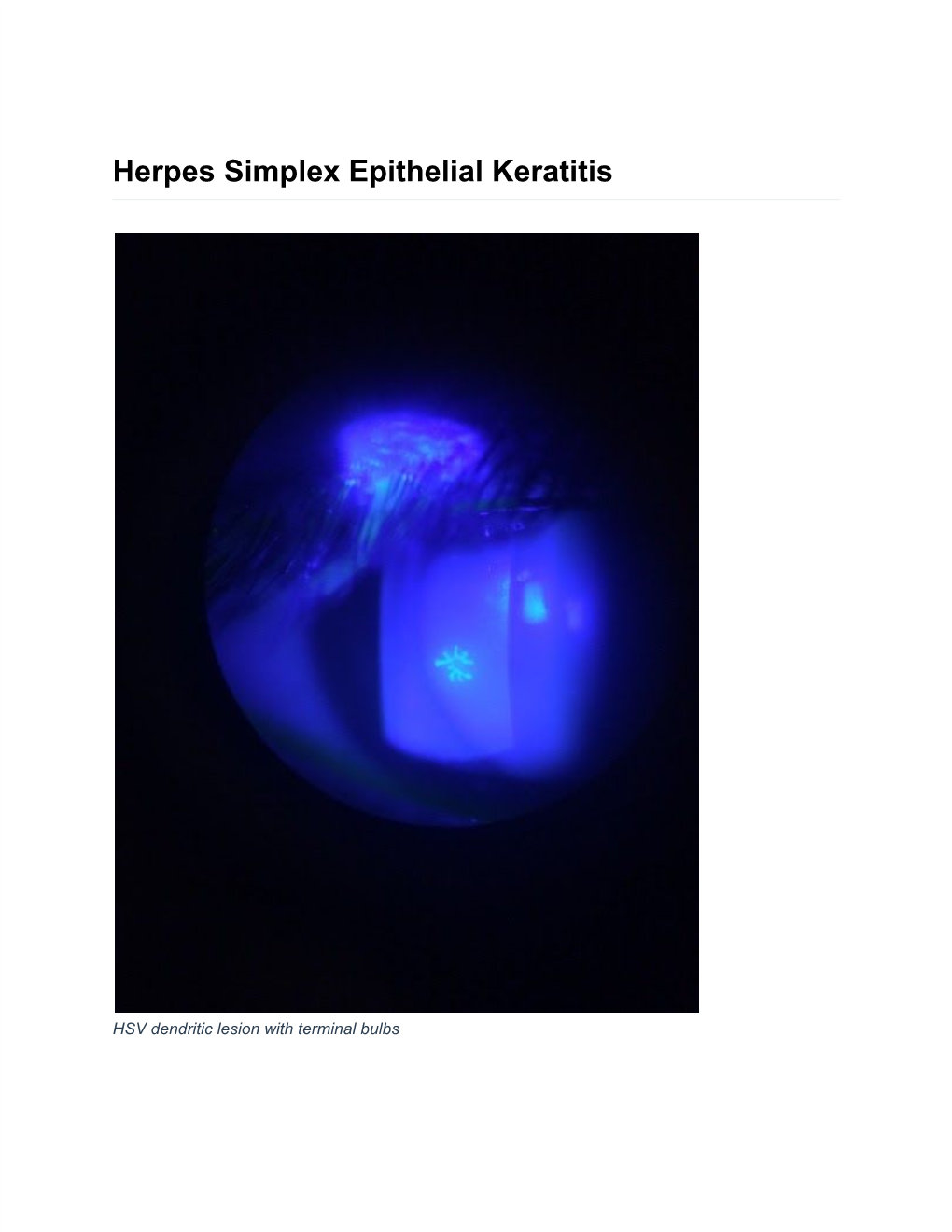 Herpes Simplex Epithelial Keratitis