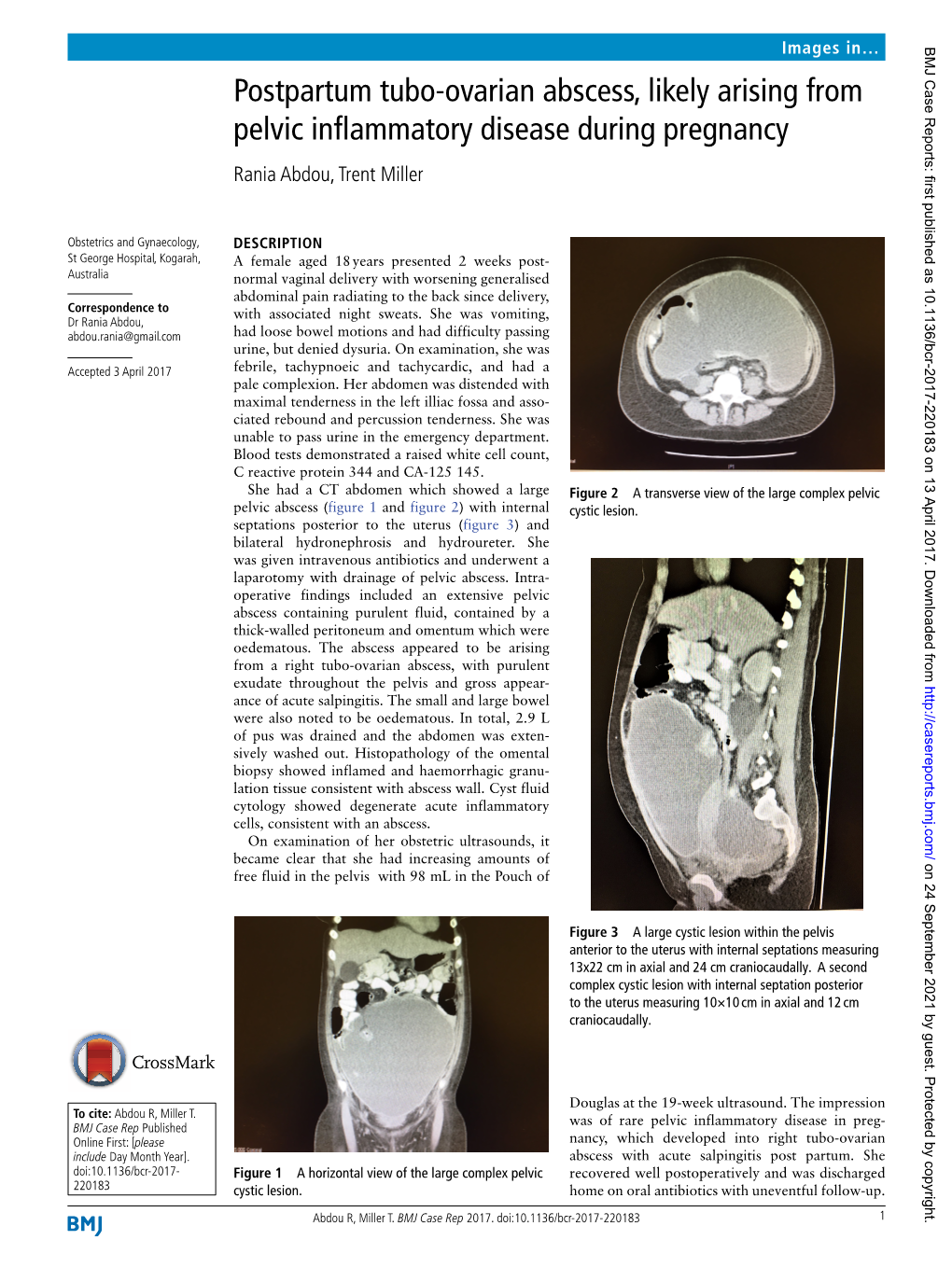 Postpartum Tubo-Ovarian Abscess, Likely Arising from Pelvic Inflammatory Disease During Pregnancy Rania Abdou, Trent Miller