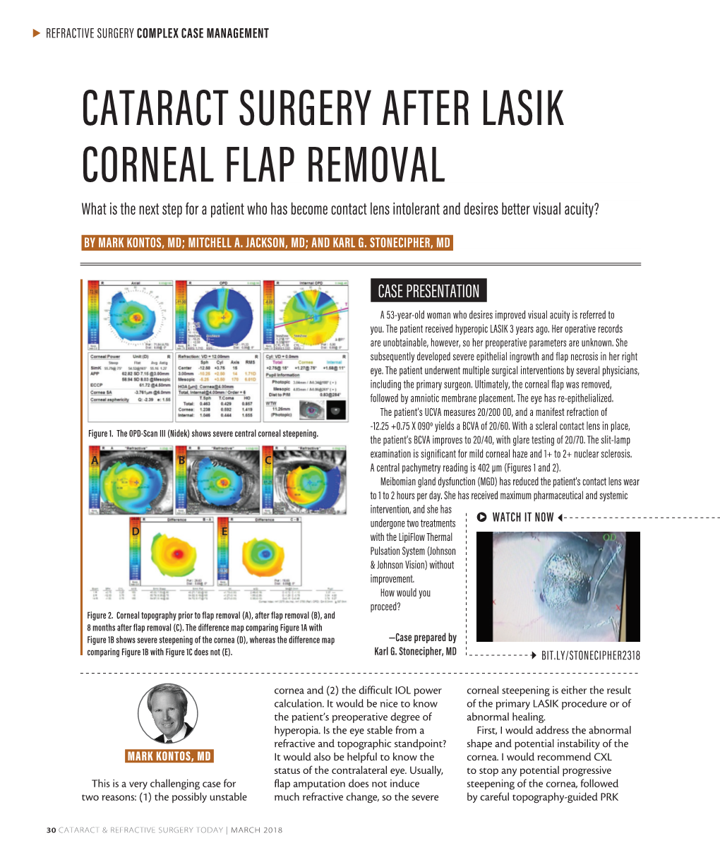 CATARACT SURGERY AFTER LASIK CORNEAL FLAP REMOVAL What Is the Next Step for a Patient Who Has Become Contact Lens Intolerant and Desires Better Visual Acuity?