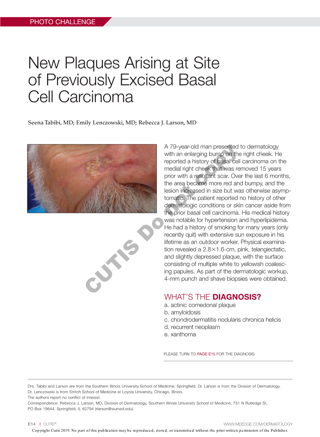 New Plaques Arising at Site of Previously Excised Basal Cell Carcinoma