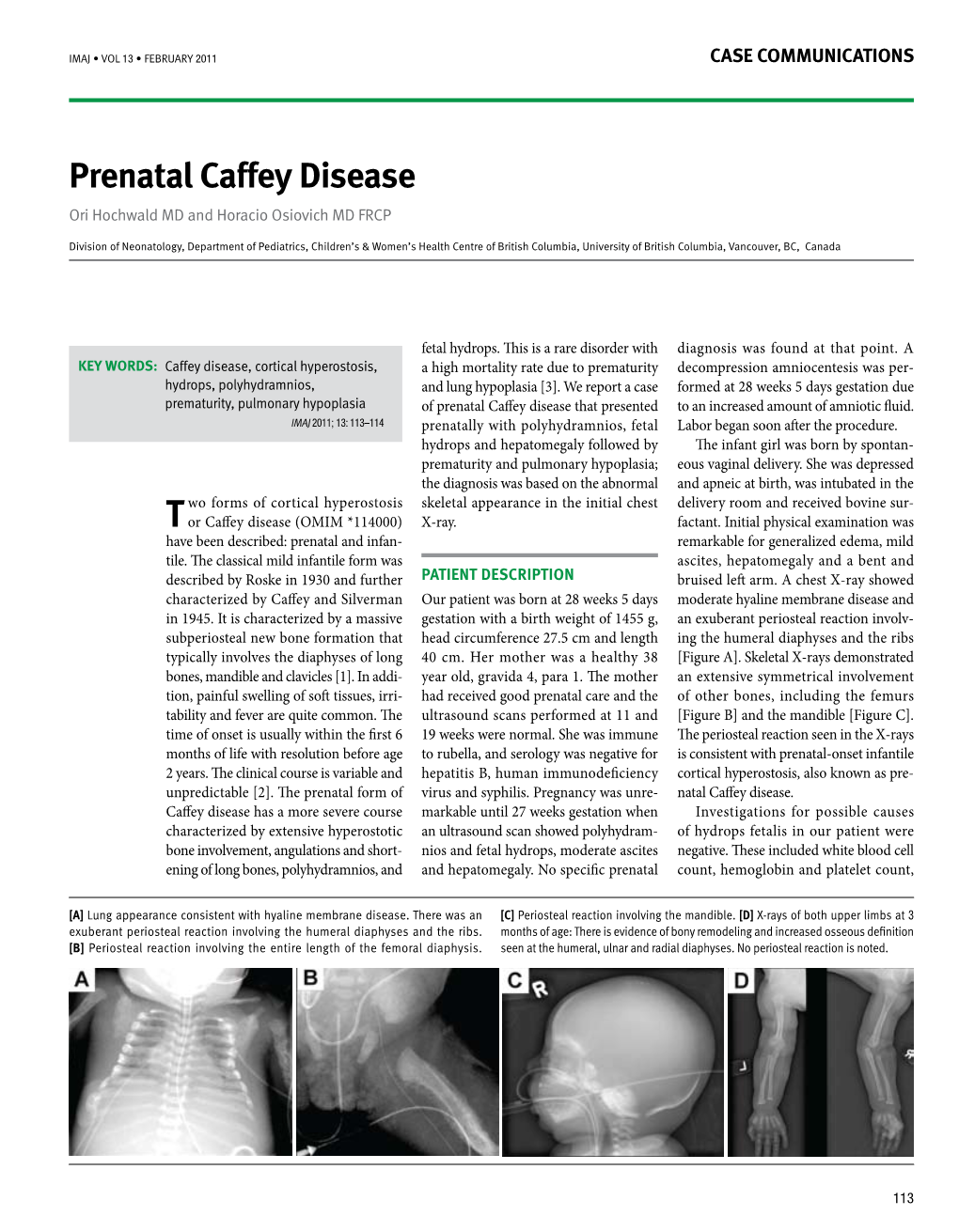 Prenatal Caffey Disease Ori Hochwald MD and Horacio Osiovich MD FRCP