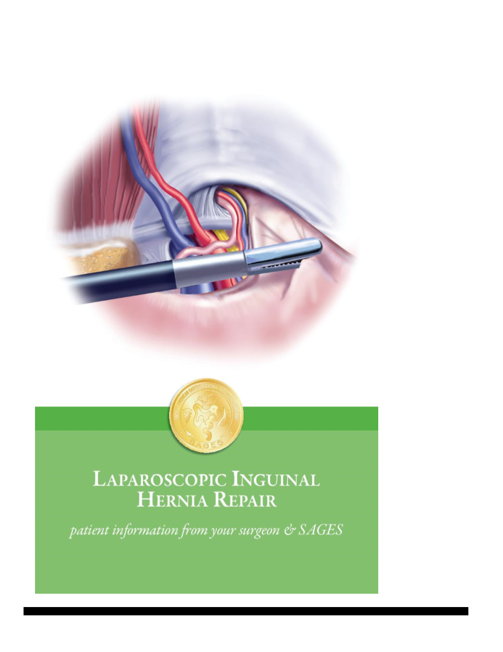 Laparoscopic Inguinal Hernia Repair Surgery Patient Information From