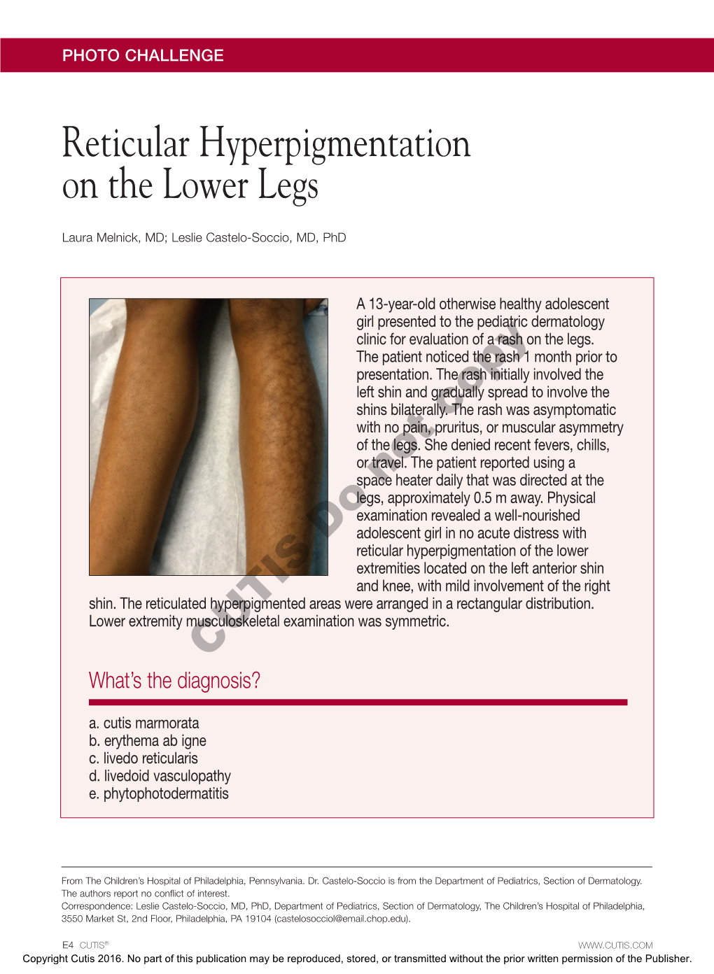 Reticular Hyperpigmentation on the Lower Legs