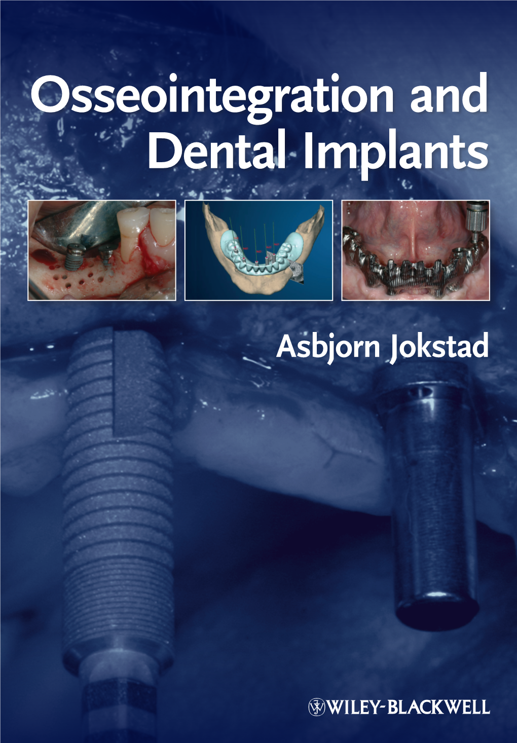 Osseointegration and Dental Implants