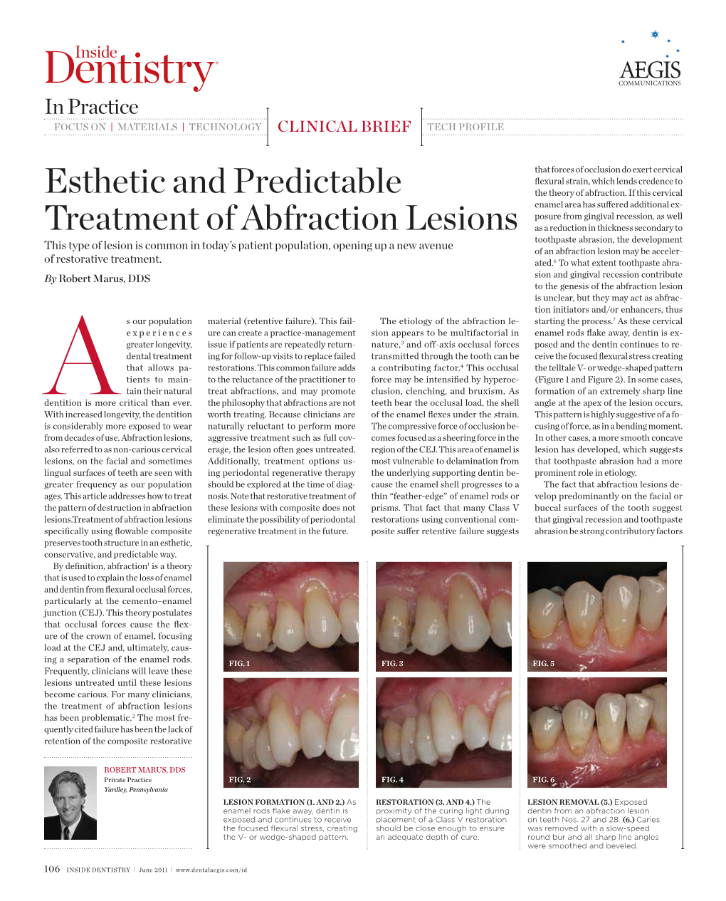 Esthetic and Predictable Treatment of Abfraction Lesions