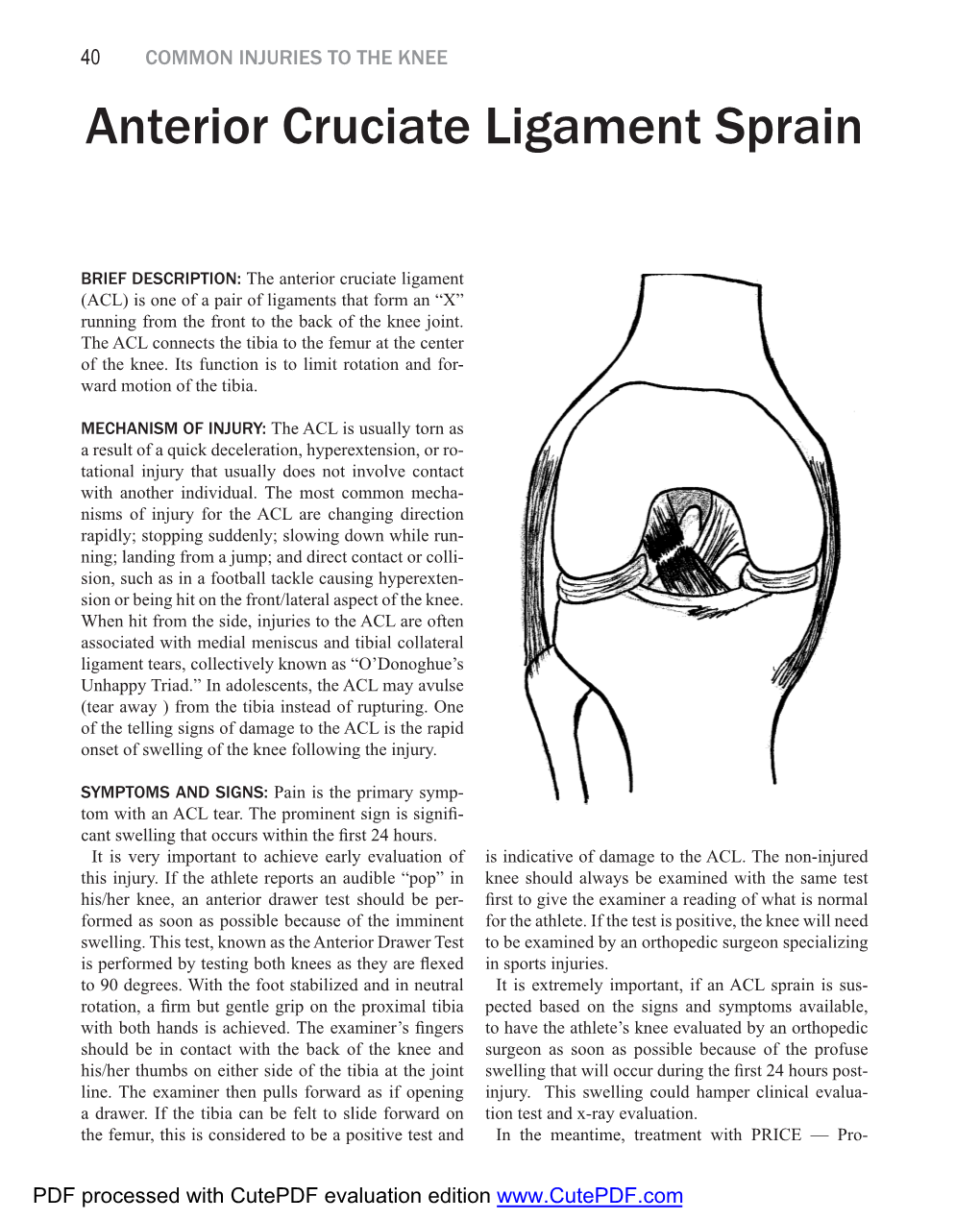 Anterior Cruciate Ligament Sprain