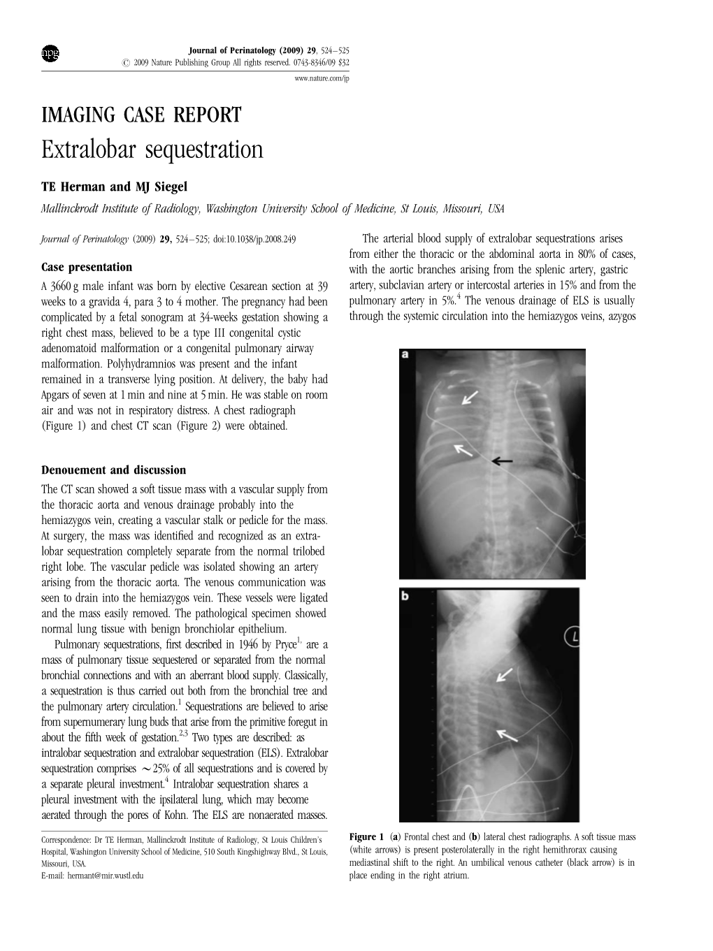 IMAGING CASE REPORT Extralobar Sequestration