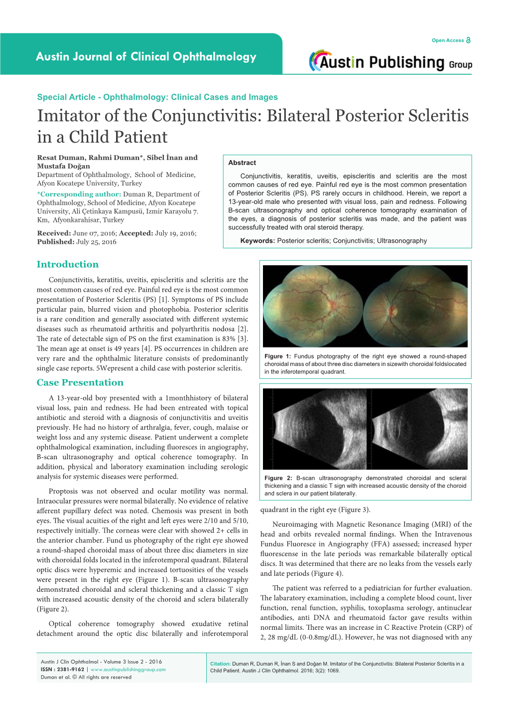 Imitator of the Conjunctivitis: Bilateral Posterior Scleritis in a Child Patient