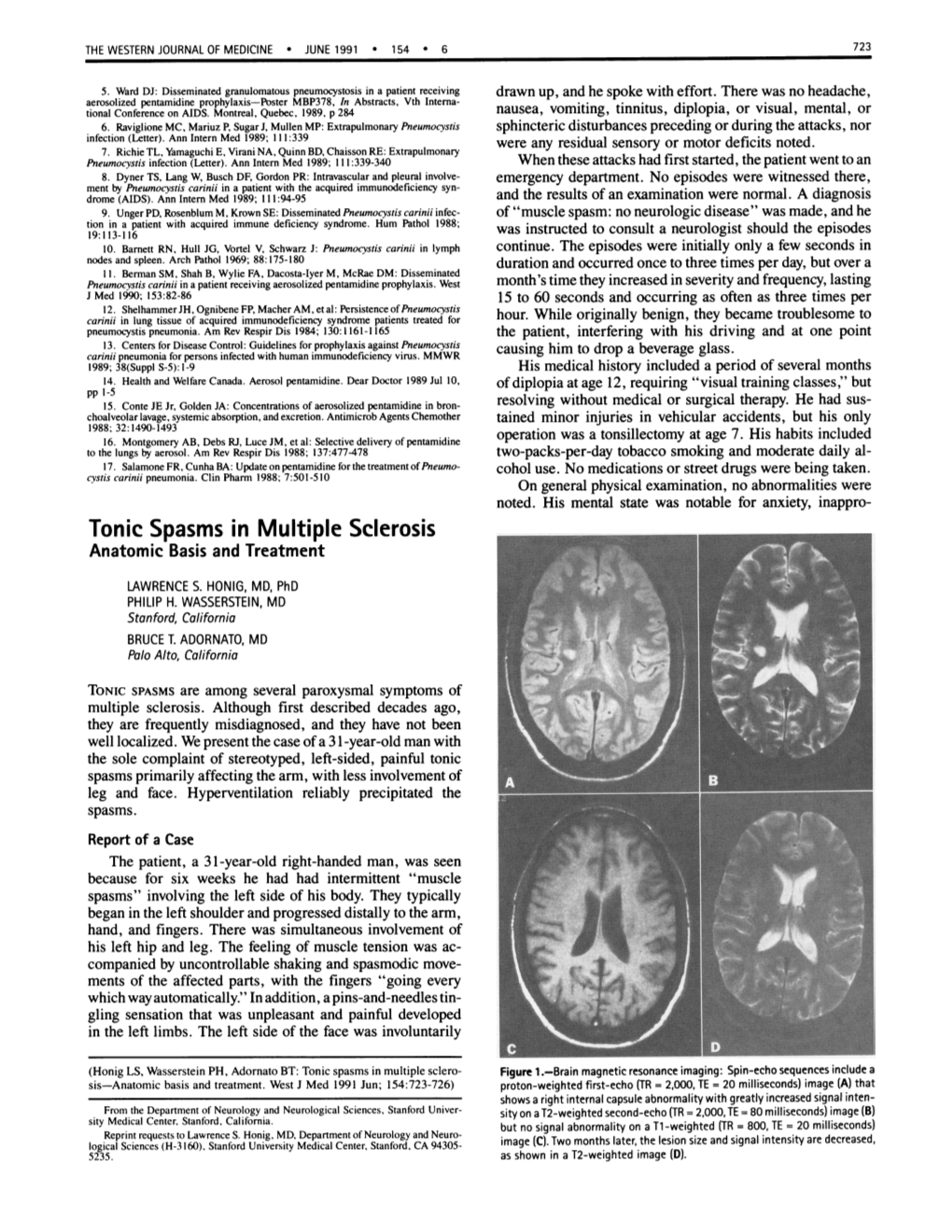 Tonic Spasms in Multiple Sclerosis Anatomic Basis and Treatment LAWRENCE S