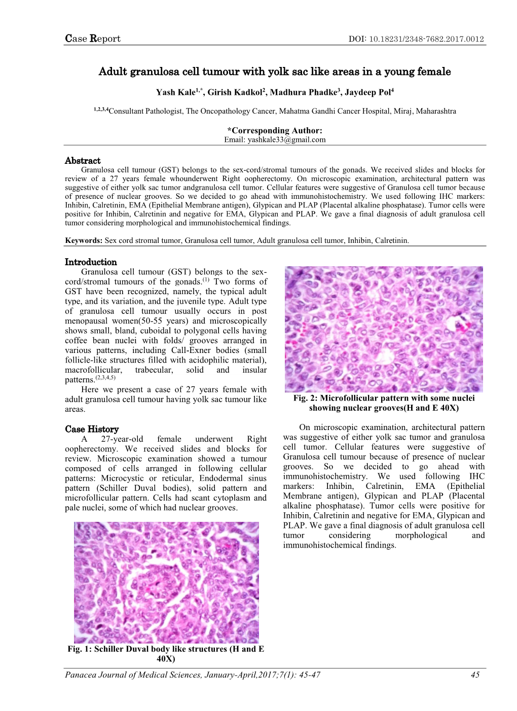 Adult Granulosa Cell Tumour with Yolk Sac Like Areas in a Young Female