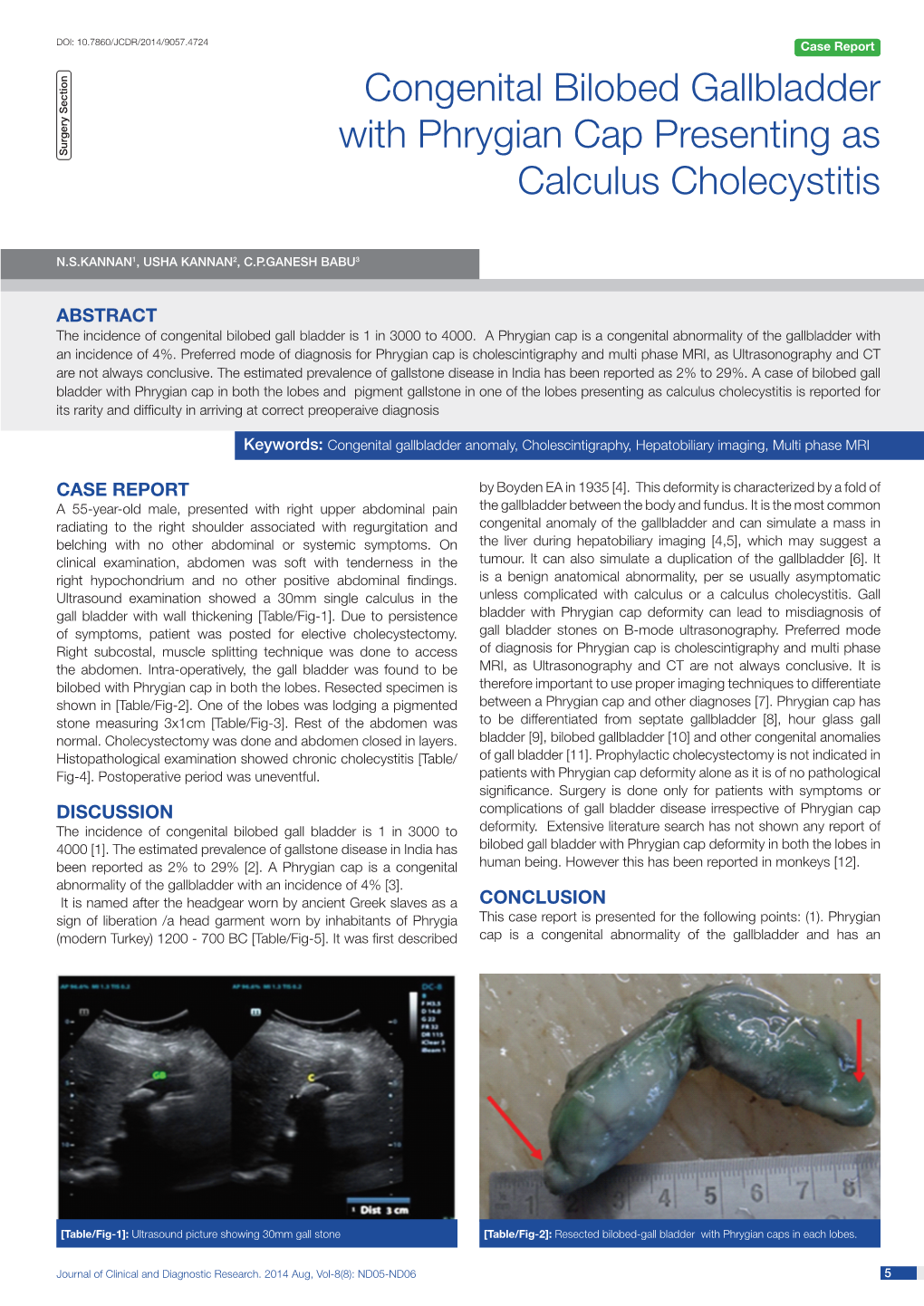 Congenital Bilobed Gallbladder with Phrygian Cap Presenting As Surgery Section Calculus Cholecystitis