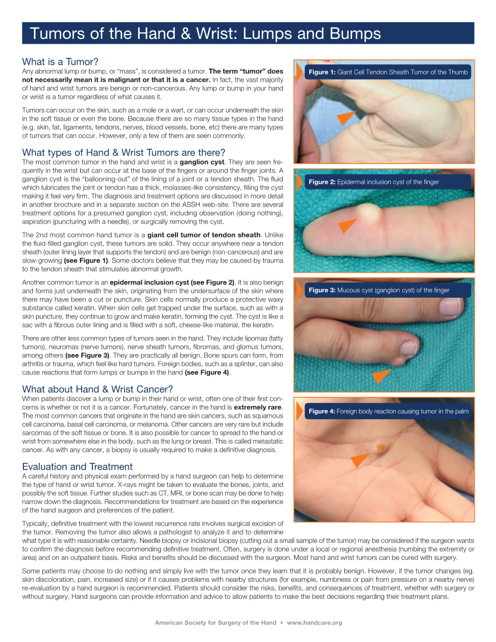 Tumors of the Hand & Wrist: Lumps and Bumps