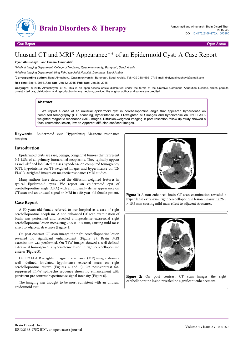 Unusual CT and MRI? Appearance** of an Epidermoid Cyst: a Case Report