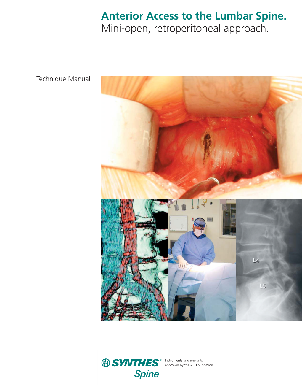 Anterior Access to the Lumbar Spine. Mini-Open, Retroperitoneal Approach