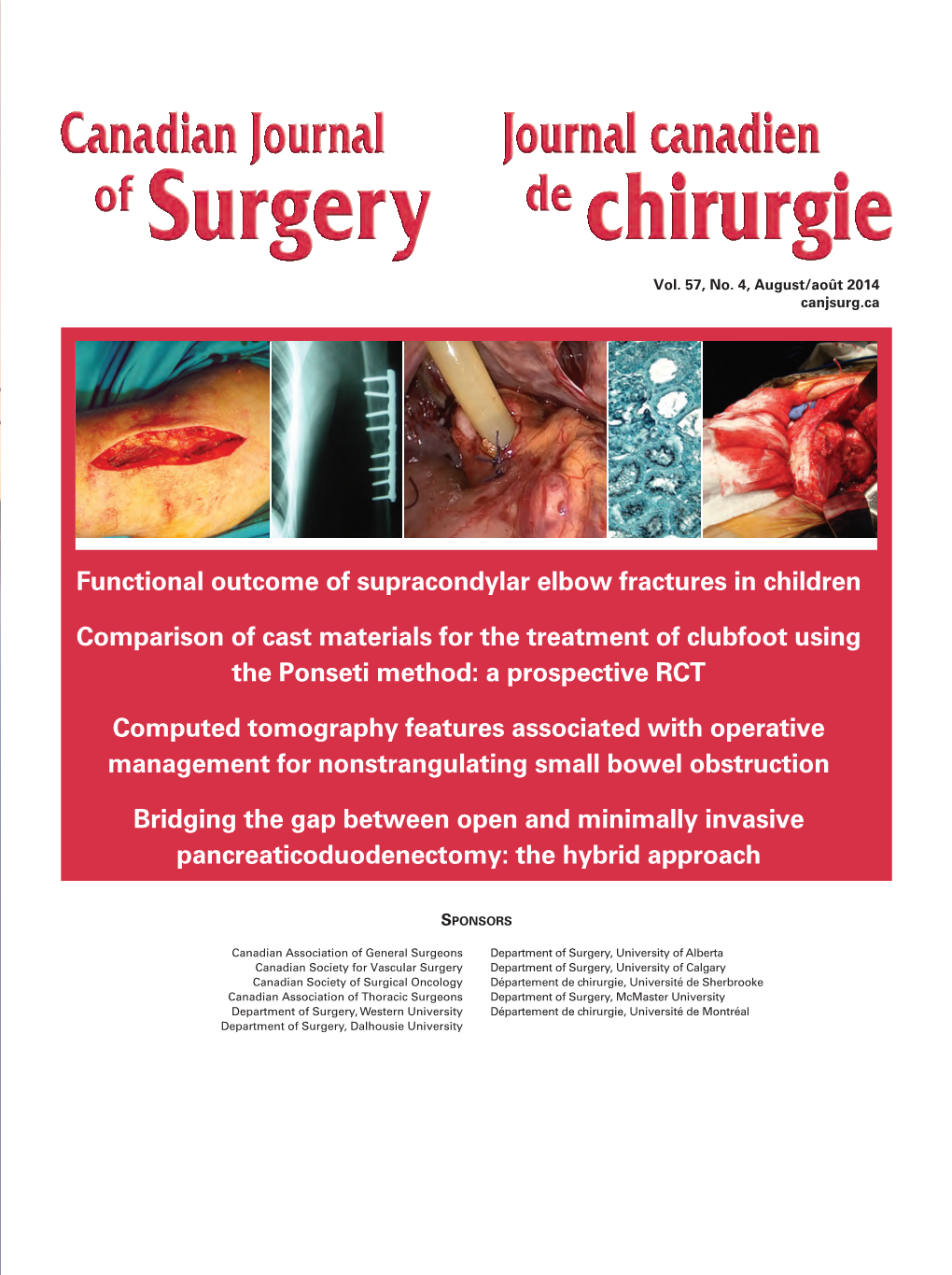 Functional Outcome of Supracondylar Elbow Fractures in Children Comparison of Cast Materials for the Treatment of Clubfoot Using